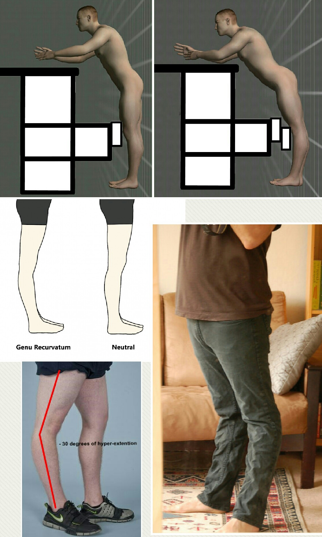 Hyperextension of the knee (Genu Recurvatum) Hyperextension of the knee (Genu Recurvatum)